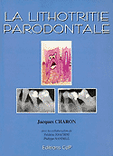 La lithotritie parodontale - J.CHARON - CDP - 