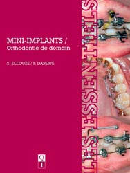 Mini-implants - S. ELLOUZE, F. DARQU - QUINTESSENCE INTERNATIONAL - 