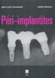 Pri-implantites - Jean-Louis GIOVANNOLI, Stefan RENVERT - QUINTESSENCE INTERNATIONAL - 